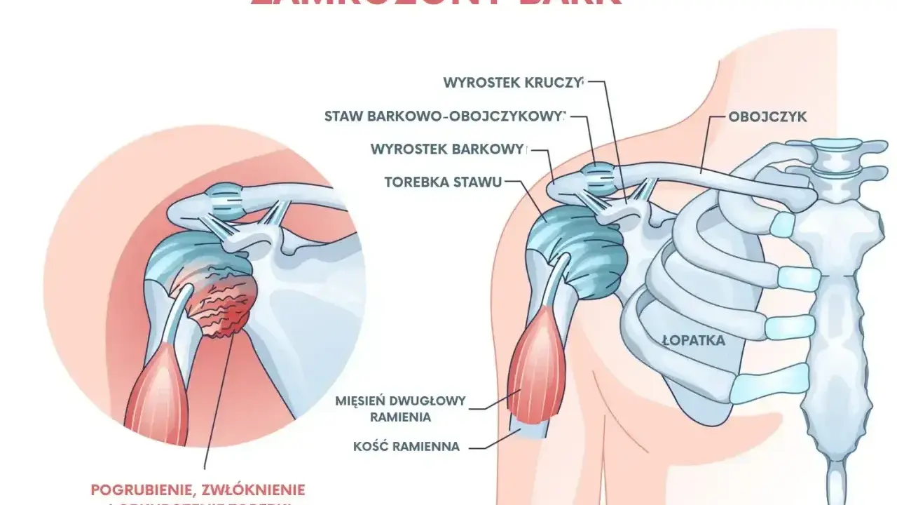 Ilustracja przedstawia zamrożony bark, ukazując pogrubienie, zwłóknienie i obkurczenie torebki stawu, co jest częstym urazem barku.