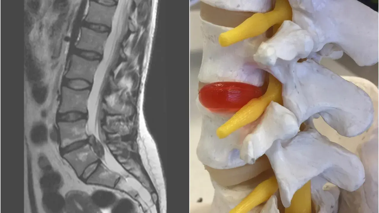 MRI kręgosłupa lędźwiowego i model anatomiczny ukazujący wysięk w stawach międzykręgowych, uciskający na nerw.