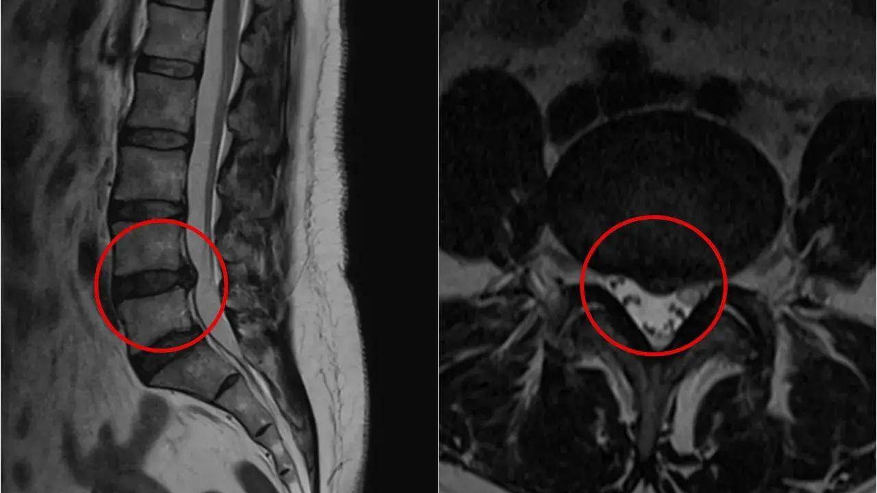 Obraz MRI kręgosłupa lędźwiowego z zaznaczoną szerokopodstawną protruzją krążka międzykręgowego, uciskającą na worek oponowy.
