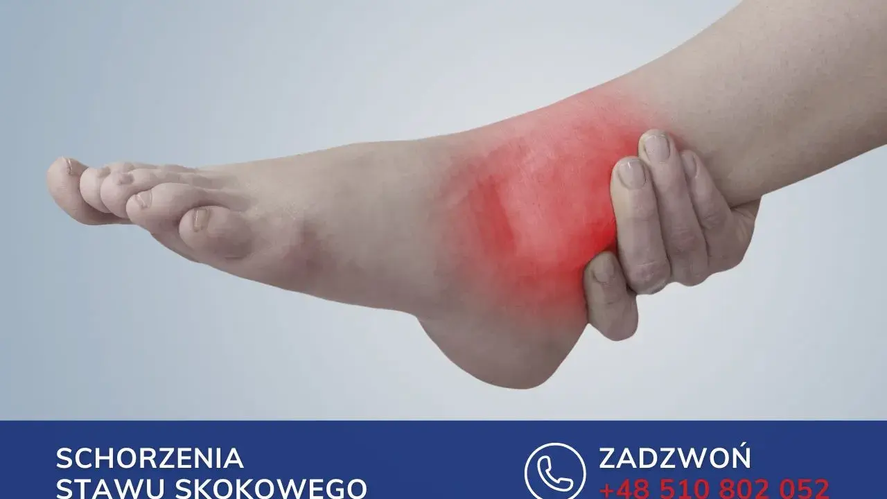 Obrzęk stopy po złamaniu kości śródstopia. Czerwony obszar wskazuje ból.
