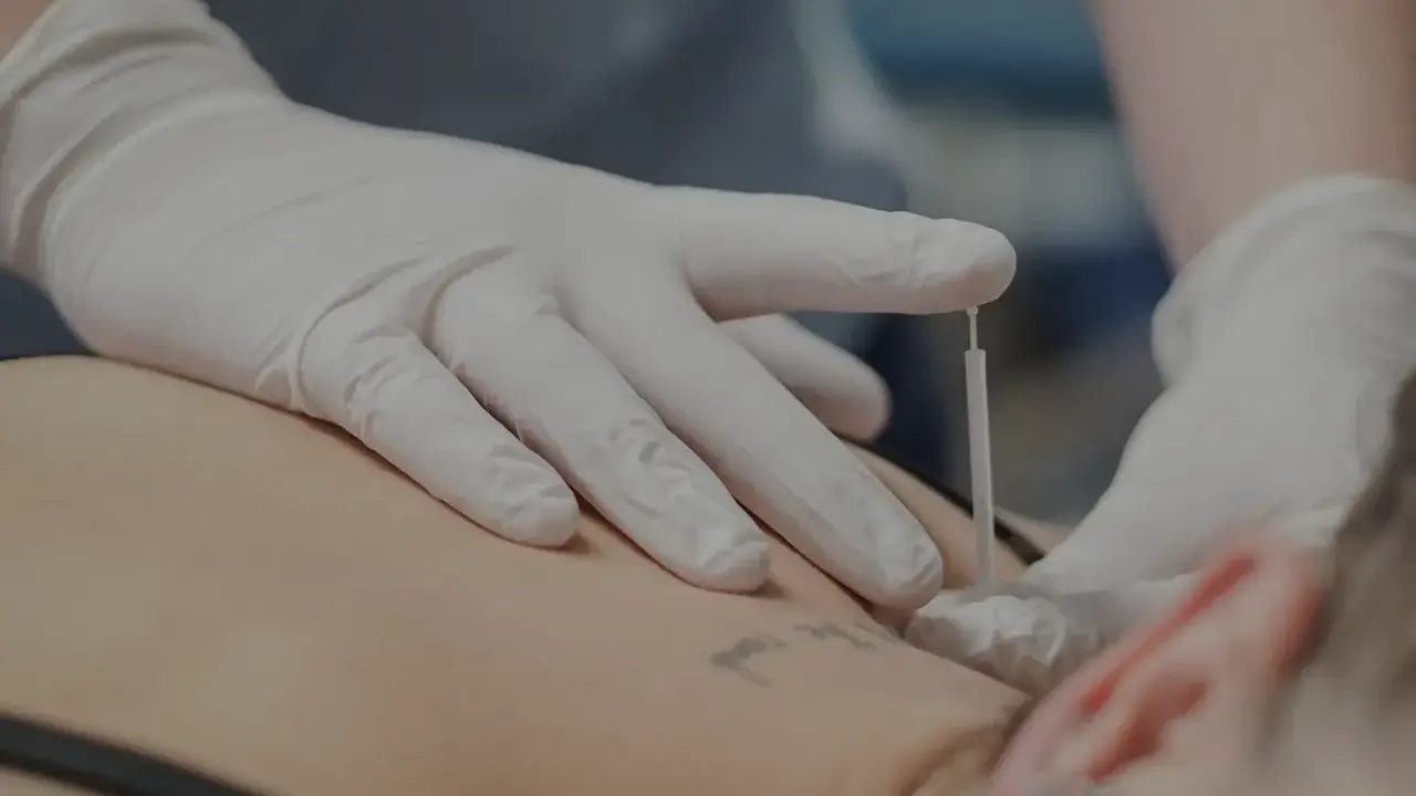 Dłoń w białej rękawiczce wykonuje zabieg suchego igłowania na plecach pacjenta.