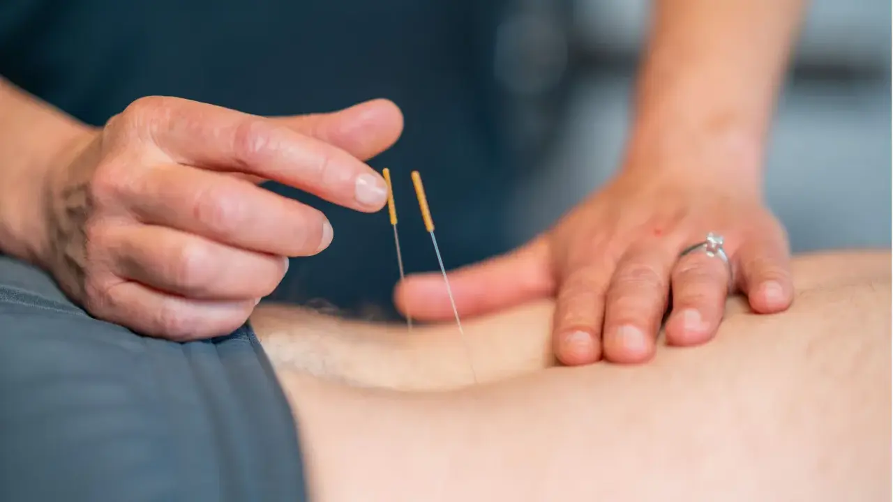 Terapeuta wykonuje suche igłowanie blizny, delikatnie wprowadzając cienkie igły w skórę pacjenta.