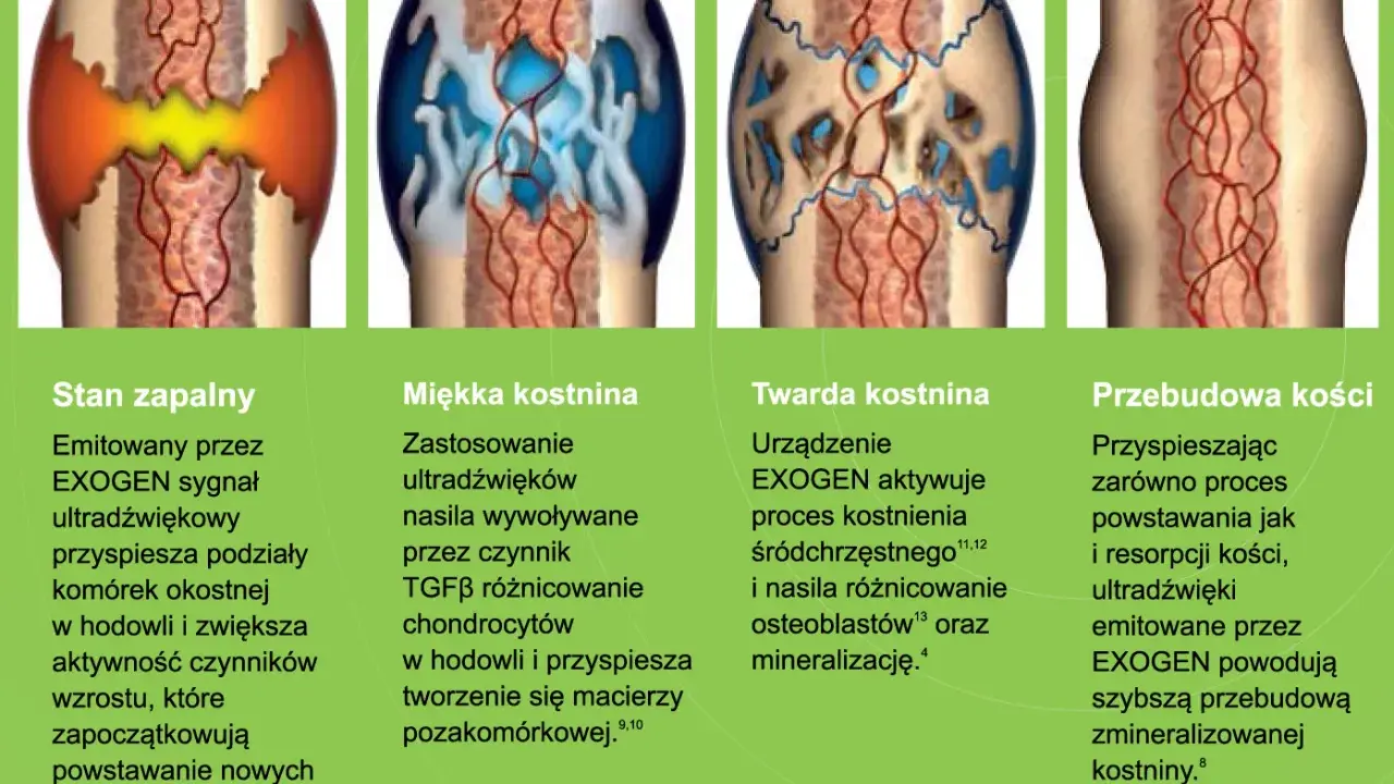 Ilustracja przedstawia etapy gojenia złamania kości: stan zapalny, tworzenie miękkiej i twardej kostniny, a na końcu przebudowę kości.