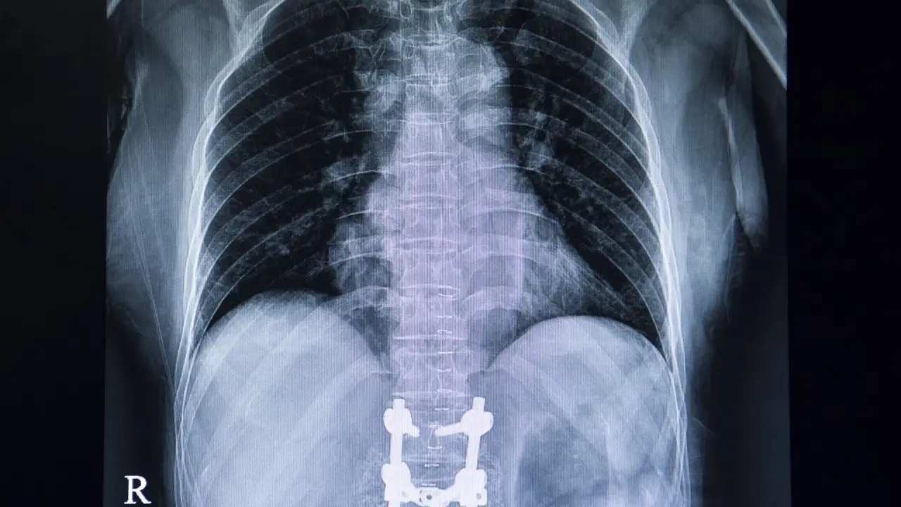 RTG klatki piersiowej z widocznymi implantami stabilizującymi kręgosłup lędźwiowy po operacji.