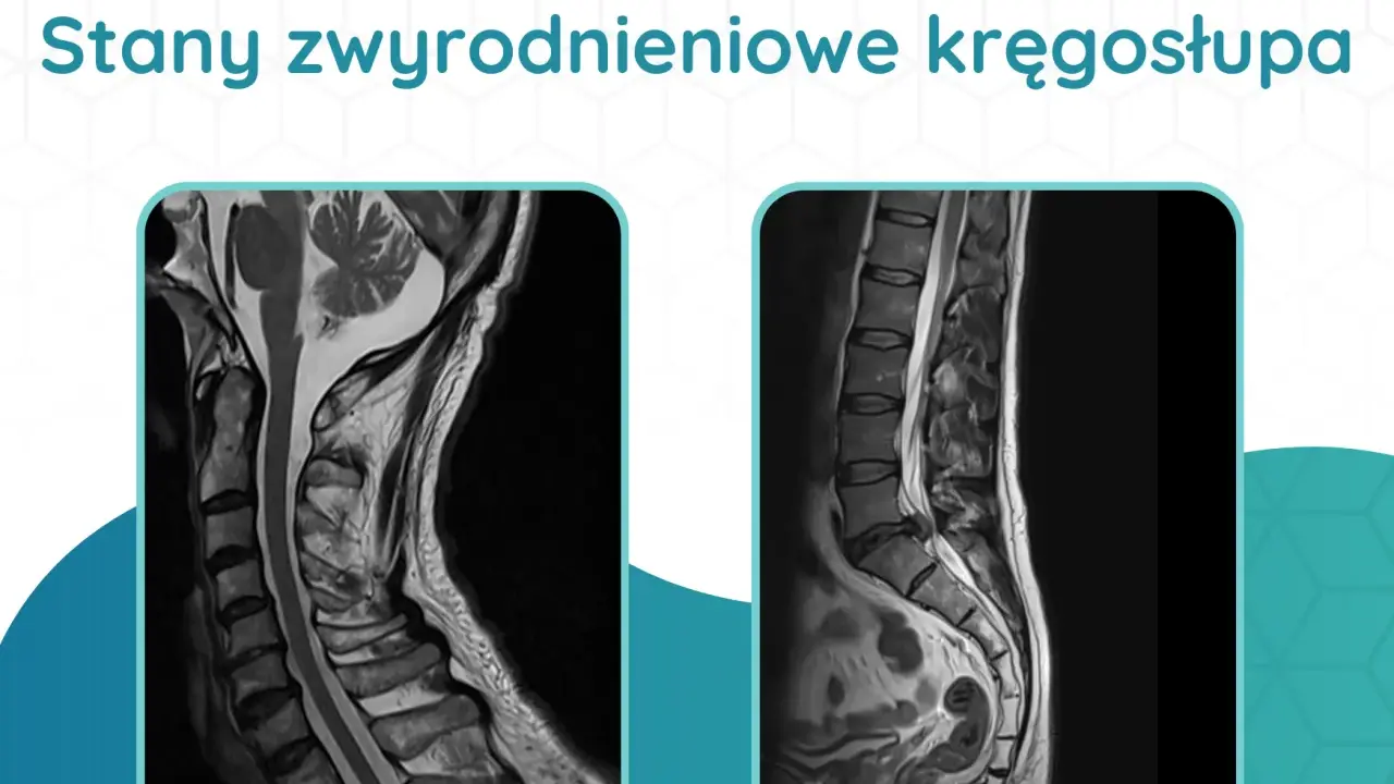 Dwa obrazy rezonansu magnetycznego kręgosłupa, ukazujące zmiany zwyrodnieniowe odcinka szyjnego i lędźwiowego.