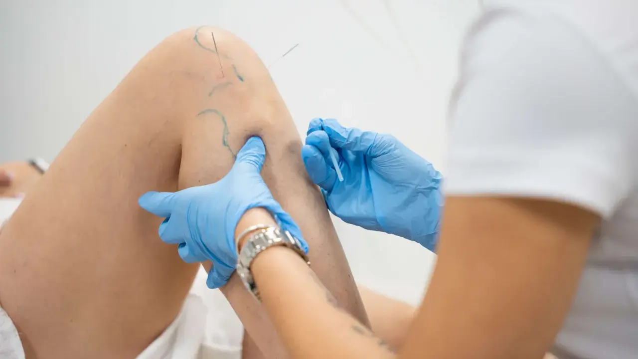 Igłoterapia kolana: specjalista w niebieskich rękawiczkach aplikuje igły. Ile zabiegów potrzeba do ulgi?