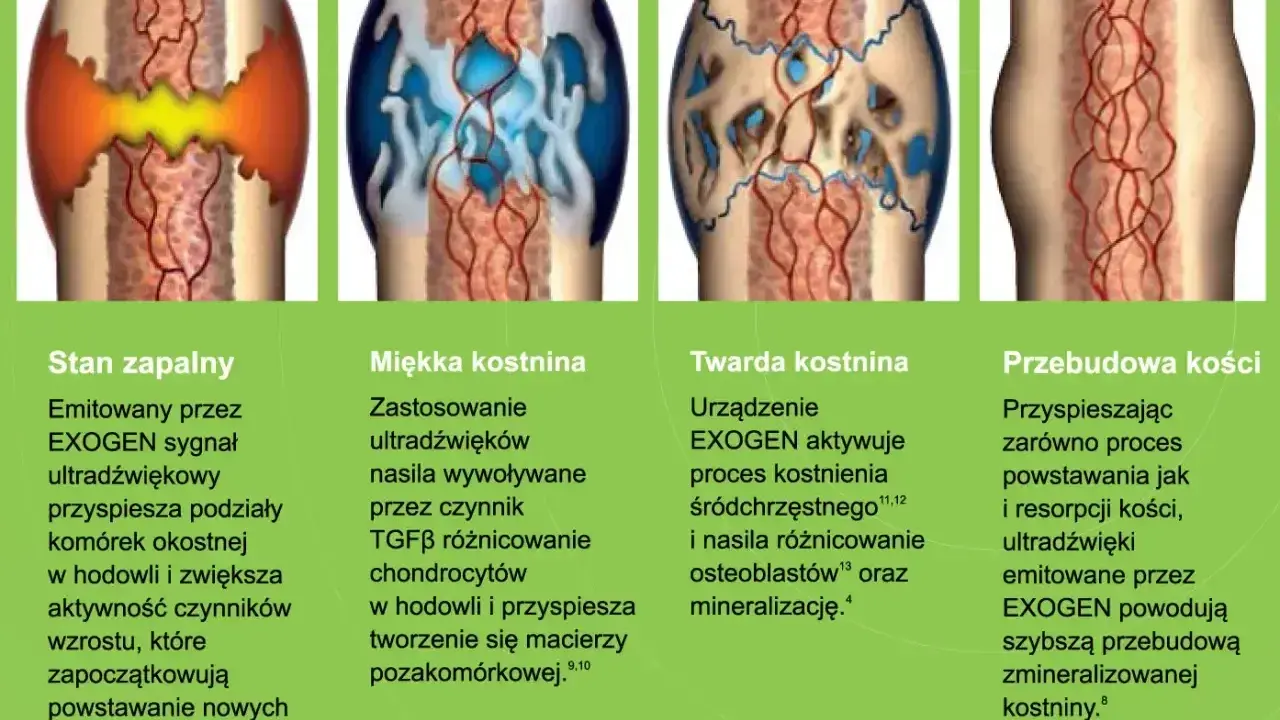 Ilustracja pokazuje etapy zrastania się kości: stan zapalny, miękką i twardą kostninę, aż do przebudowy kości.