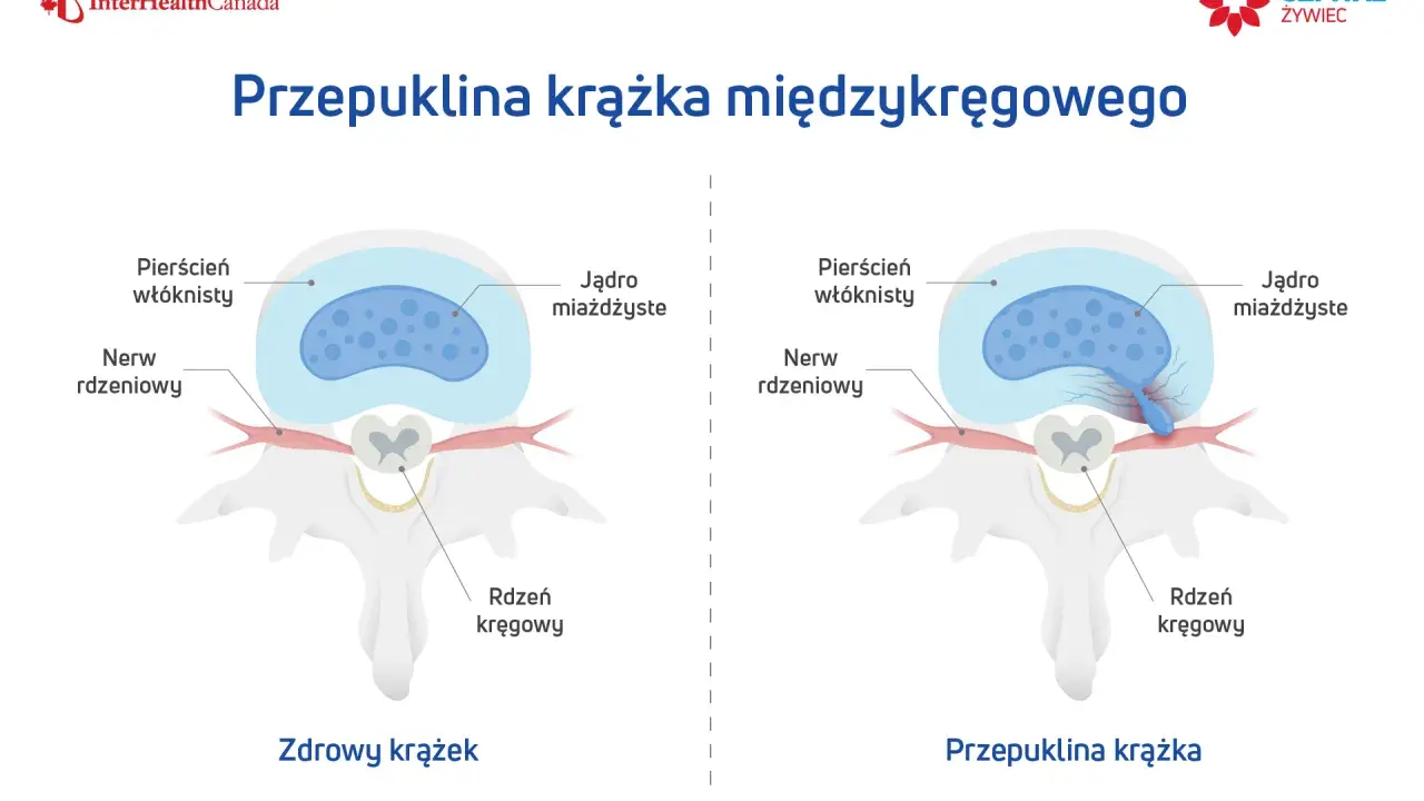 Porównanie zdrowego krążka międzykręgowego z przepukliną krążka, gdzie jądro miażdżyste uciska nerw rdzeniowy.
