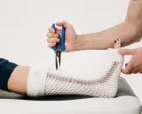 Lekarz zdejmuje gips z nogi pacjenta, przygotowując do zmiany na ortezę. Po jakim czasie można zmienić gips na ortezę?