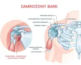 Ilustracja przedstawia zamrożony bark, ukazując pogrubienie, zwłóknienie i obkurczenie torebki stawu, co jest częstym urazem barku.