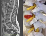 MRI kręgosłupa lędźwiowego i model anatomiczny ukazujący wysięk w stawach międzykręgowych, uciskający na nerw.