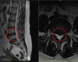 Obraz MRI kręgosłupa lędźwiowego z zaznaczoną szerokopodstawną protruzją krążka międzykręgowego, uciskającą na worek oponowy.