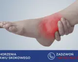 Obrzęk stopy po złamaniu kości śródstopia. Czerwony obszar wskazuje ból.
