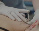 Dłoń w białej rękawiczce wykonuje zabieg suchego igłowania na plecach pacjenta.