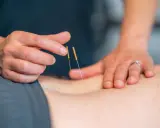 Terapeuta wykonuje suche igłowanie blizny, delikatnie wprowadzając cienkie igły w skórę pacjenta.