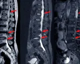 Obrazowanie MRI kręgosłupa lędźwiowego z widoczną dyskopatią, zaznaczoną czerwonymi strzałkami.