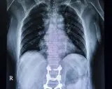 RTG klatki piersiowej z widocznymi implantami stabilizującymi kręgosłup lędźwiowy po operacji.
