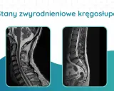 Dwa obrazy rezonansu magnetycznego kręgosłupa, ukazujące zmiany zwyrodnieniowe odcinka szyjnego i lędźwiowego.