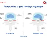 Porównanie zdrowego krążka międzykręgowego z przepukliną krążka, gdzie jądro miażdżyste uciska nerw rdzeniowy.