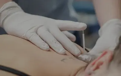 Dłoń w białej rękawiczce wykonuje zabieg suchego igłowania na plecach pacjenta.