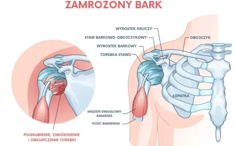 Ilustracja przedstawia zamrożony bark, ukazując pogrubienie, zwłóknienie i obkurczenie torebki stawu, co jest częstym urazem barku.