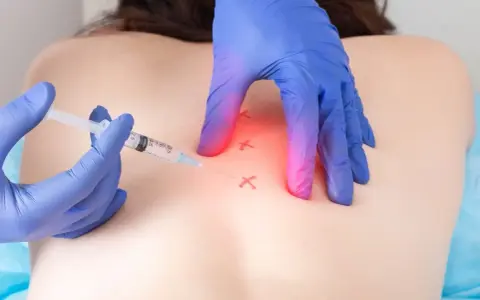 Lekarz w niebieskich rękawiczkach wykonuje zastrzyk w plecy pacjenta, przygotowując do zabiegu ablacji RF.