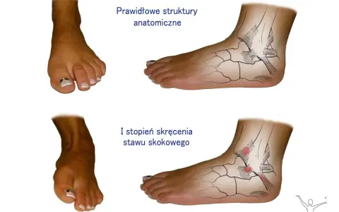 Porównanie zdrowej kostki z I stopniem skręcenia. Czy można chodzić ze skręconą kostką? Ilustracja pokazuje uszkodzone więzadła.