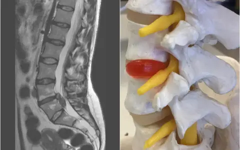 MRI kręgosłupa lędźwiowego i model anatomiczny ukazujący wysięk w stawach międzykręgowych, uciskający na nerw.