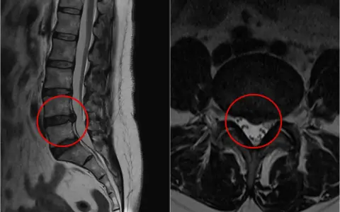 Obraz MRI kręgosłupa lędźwiowego z zaznaczoną szerokopodstawną protruzją krążka międzykręgowego, uciskającą na worek oponowy.