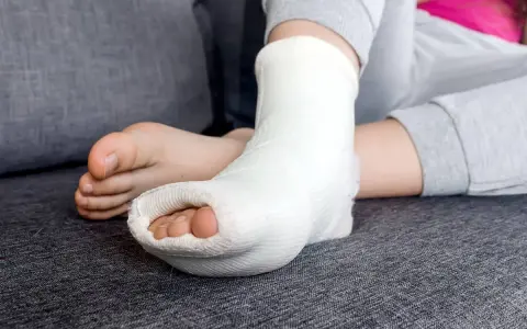 Dziecko z gipsową ortezą na nodze, która właśnie została zdjęta. Palce stopy są widoczne.