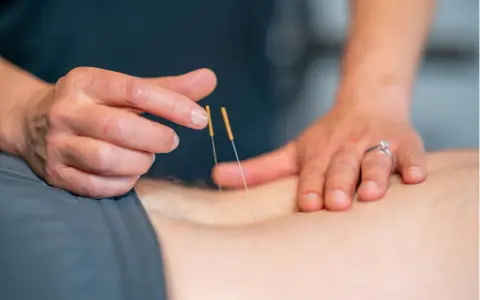 Terapeuta wykonuje suche igłowanie blizny, delikatnie wprowadzając cienkie igły w skórę pacjenta.