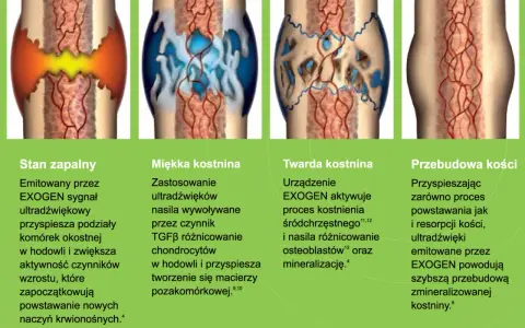 Ilustracja przedstawia etapy gojenia złamania kości: stan zapalny, tworzenie miękkiej i twardej kostniny, a na końcu przebudowę kości.