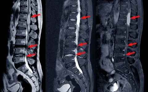 Obrazowanie MRI kręgosłupa lędźwiowego z widoczną dyskopatią, zaznaczoną czerwonymi strzałkami.