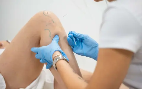 Igłoterapia kolana: specjalista w niebieskich rękawiczkach aplikuje igły. Ile zabiegów potrzeba do ulgi?