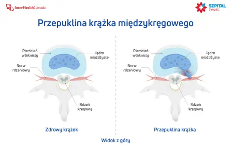Porównanie zdrowego krążka międzykręgowego z przepukliną krążka, gdzie jądro miażdżyste uciska nerw rdzeniowy.