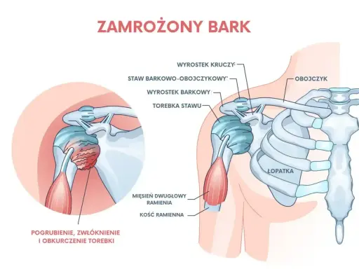 Ilustracja przedstawia zamrożony bark, ukazując pogrubienie, zwłóknienie i obkurczenie torebki stawu, co jest częstym urazem barku.
