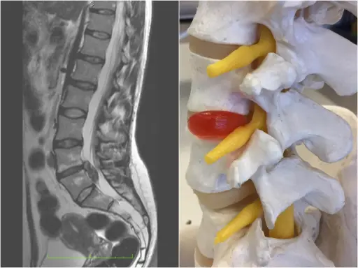 MRI kręgosłupa lędźwiowego i model anatomiczny ukazujący wysięk w stawach międzykręgowych, uciskający na nerw.
