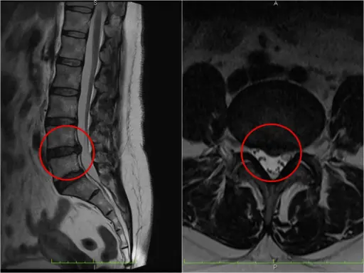 Obraz MRI kręgosłupa lędźwiowego z zaznaczoną szerokopodstawną protruzją krążka międzykręgowego, uciskającą na worek oponowy.