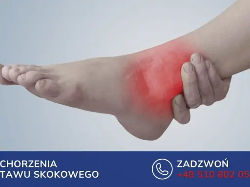 Obrzęk stopy po złamaniu kości śródstopia. Czerwony obszar wskazuje ból.