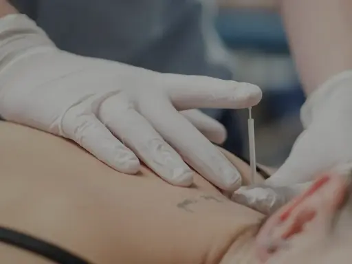Dłoń w białej rękawiczce wykonuje zabieg suchego igłowania na plecach pacjenta.