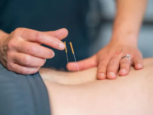 Terapeuta wykonuje suche igłowanie blizny, delikatnie wprowadzając cienkie igły w skórę pacjenta.