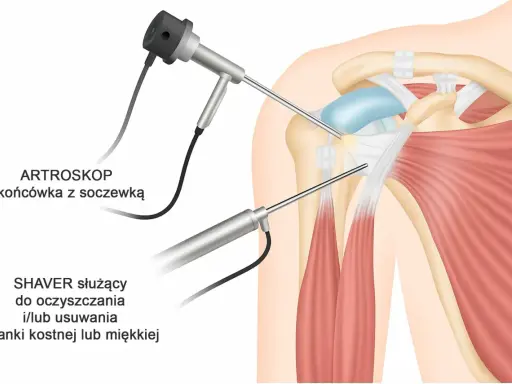 Artroskopia barku: artroskop i shaver pracują w okolicy mięśnia piersiowego mniejszego, oczyszczając tkanki.