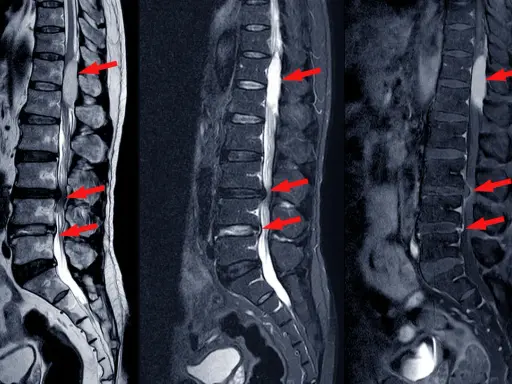 Obrazowanie MRI kręgosłupa lędźwiowego z widoczną dyskopatią, zaznaczoną czerwonymi strzałkami.