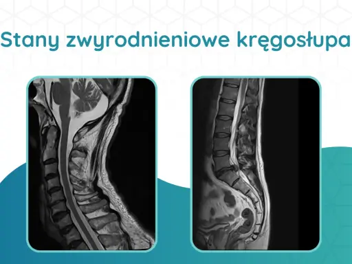 Dwa obrazy rezonansu magnetycznego kręgosłupa, ukazujące zmiany zwyrodnieniowe odcinka szyjnego i lędźwiowego.