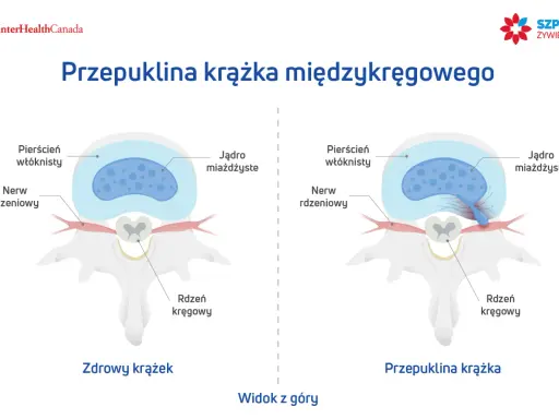 Porównanie zdrowego krążka międzykręgowego z przepukliną krążka, gdzie jądro miażdżyste uciska nerw rdzeniowy.
