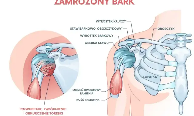 Ilustracja przedstawia zamrożony bark, ukazując pogrubienie, zwłóknienie i obkurczenie torebki stawu, co jest częstym urazem barku.