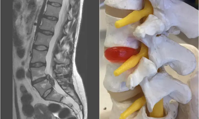 MRI kręgosłupa lędźwiowego i model anatomiczny ukazujący wysięk w stawach międzykręgowych, uciskający na nerw.