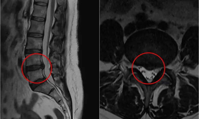 Obraz MRI kręgosłupa lędźwiowego z zaznaczoną szerokopodstawną protruzją krążka międzykręgowego, uciskającą na worek oponowy.