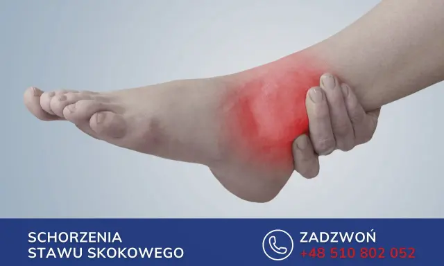Obrzęk stopy po złamaniu kości śródstopia. Czerwony obszar wskazuje ból.