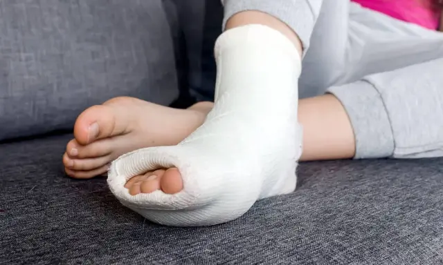 Dziecko z gipsową ortezą na nodze, która właśnie została zdjęta. Palce stopy są widoczne.
